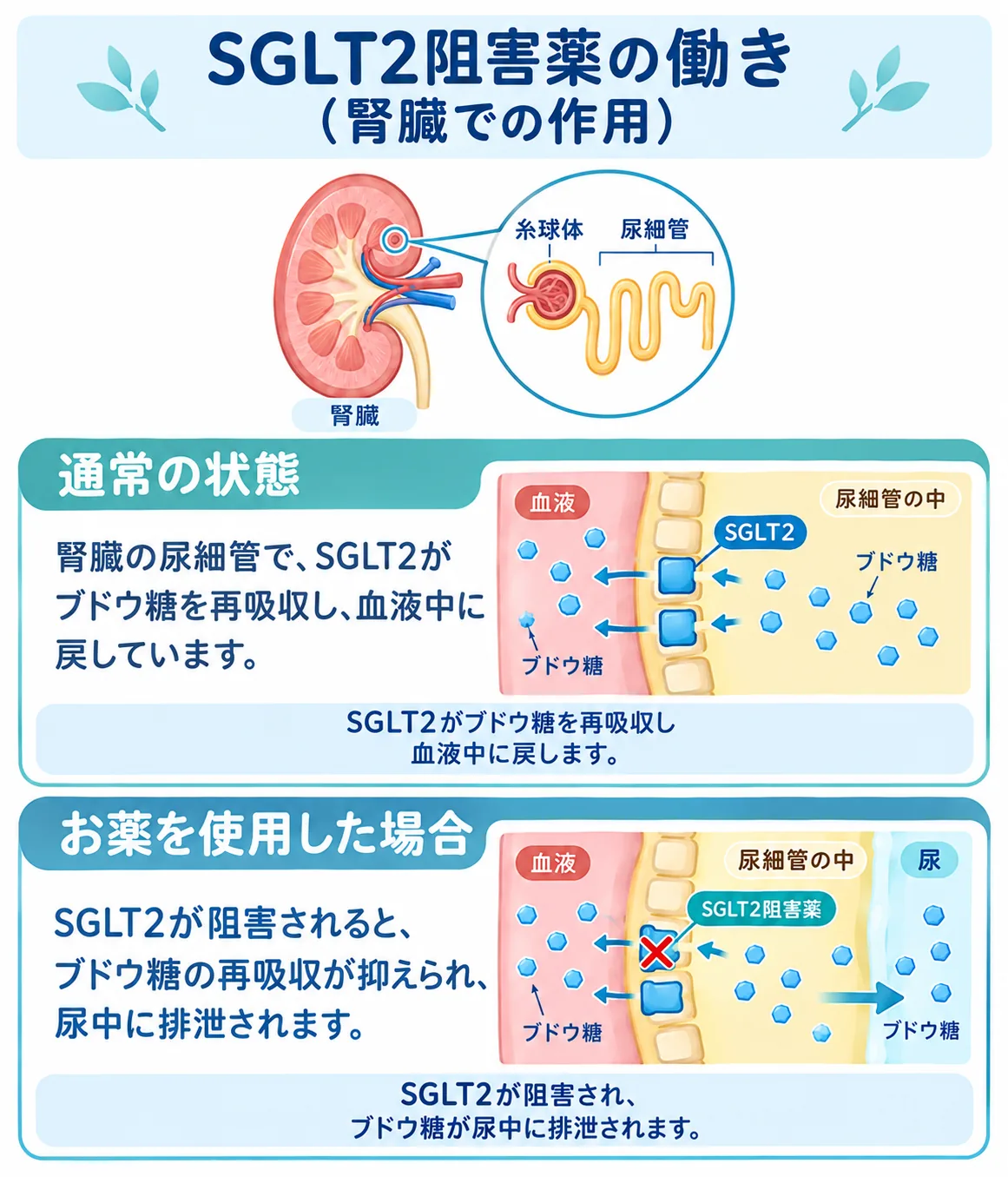 SGLT2阻害薬の働きの図：通常は腎臓の尿細管でSGLT2がブドウ糖を再吸収して血液中に戻すが、お薬を使用するとSGLT2が阻害され、ブドウ糖の再吸収が抑えられて尿中に排泄される