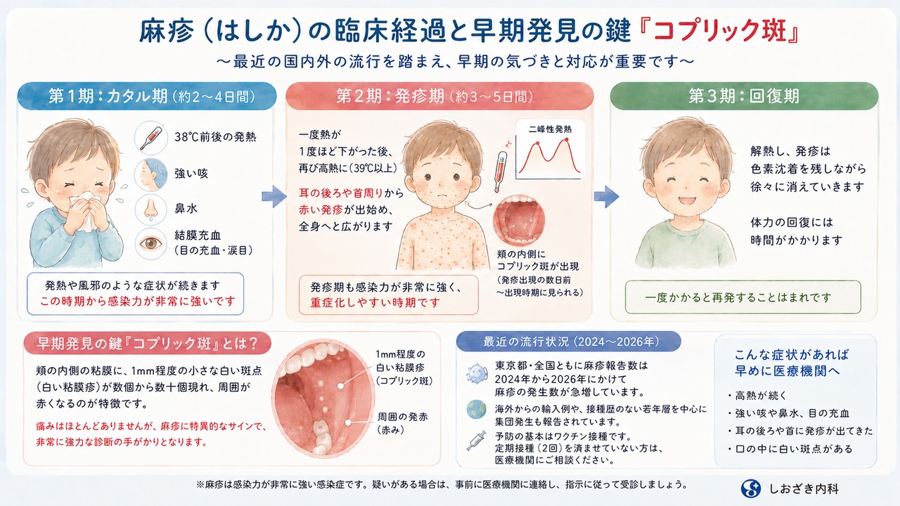 麻疹（はしか）の臨床経過とコプリック斑の解説図